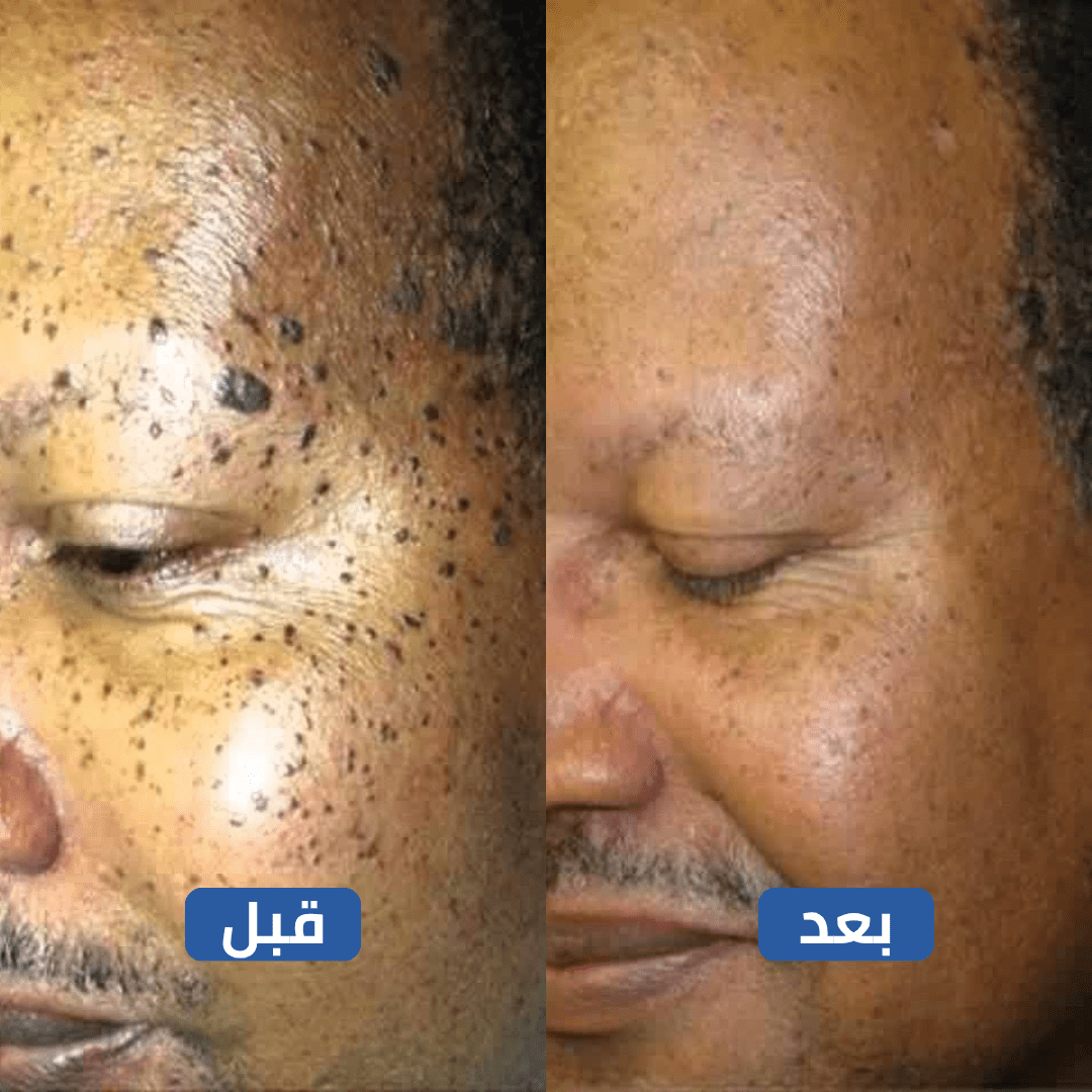 بسيل: انتهِ من كابوس الثآليل واستعد لبشرة مثالية تعيد لك حياتك