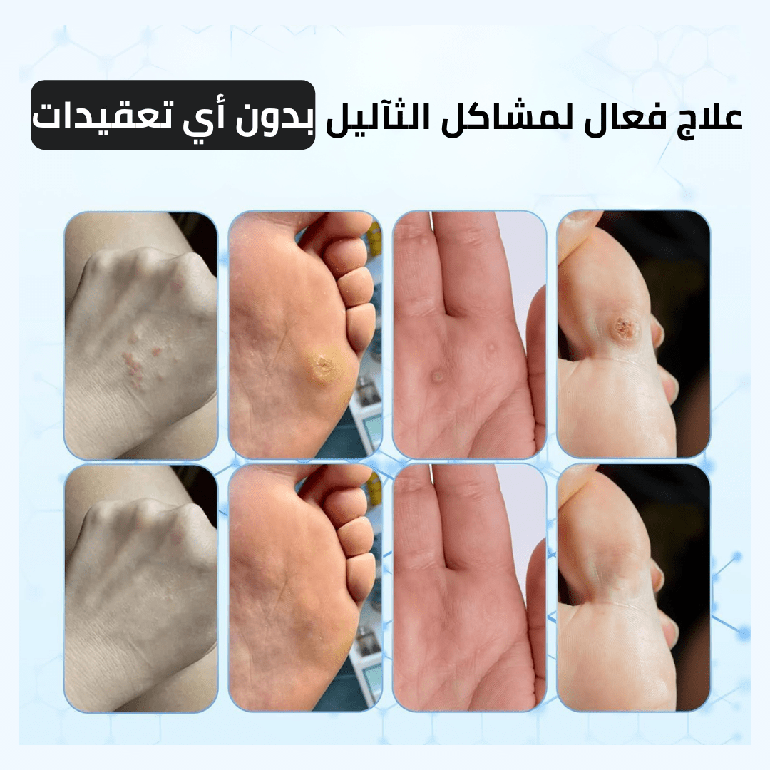 بسيل: انتهِ من كابوس الثآليل واستعد لبشرة مثالية تعيد لك حياتك