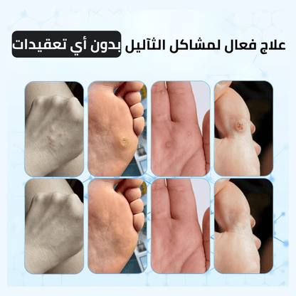 بسيل: انتهِ من كابوس الثآليل واستعد لبشرة مثالية تعيد لك حياتك