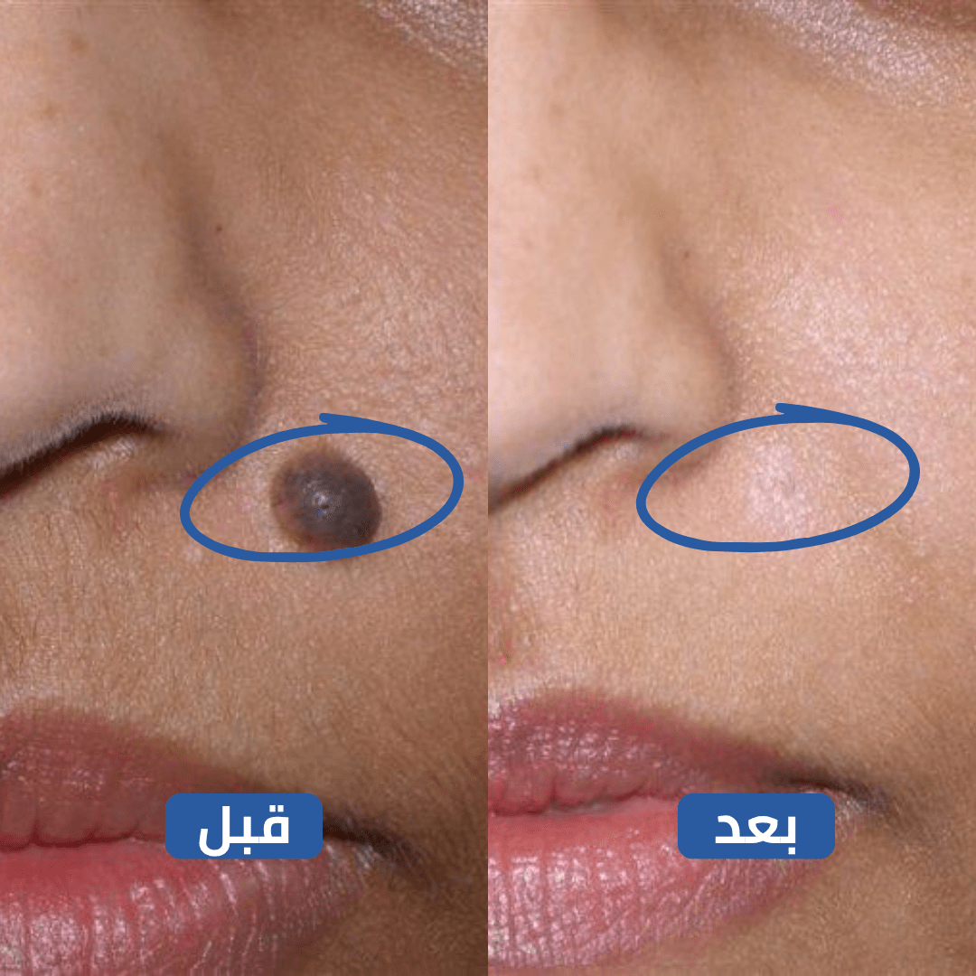 بسيل: انتهِ من كابوس الثآليل واستعد لبشرة مثالية تعيد لك حياتك